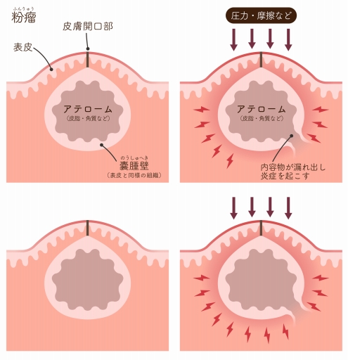 粉瘤の原因と診断