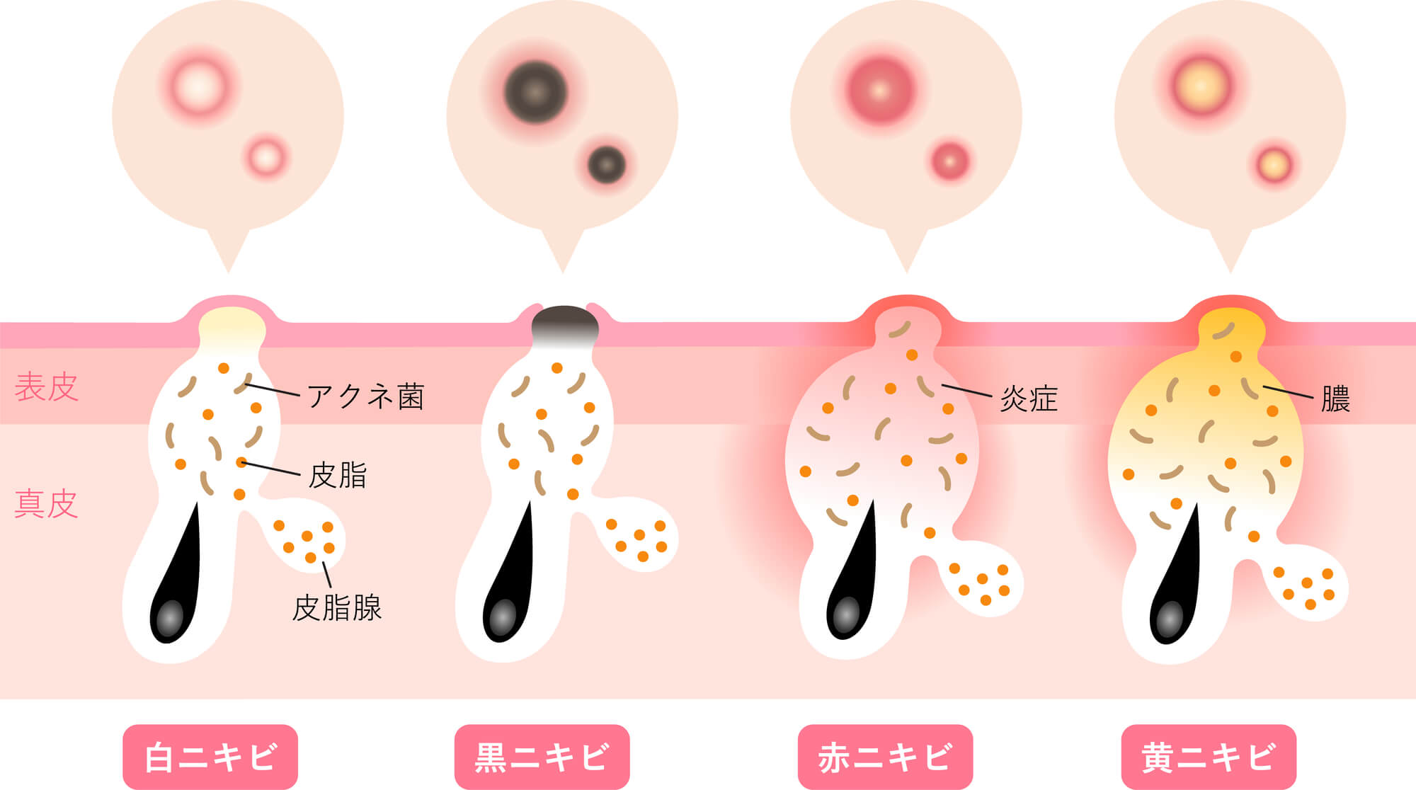 ニキビ・ニキビ跡の種類と原因